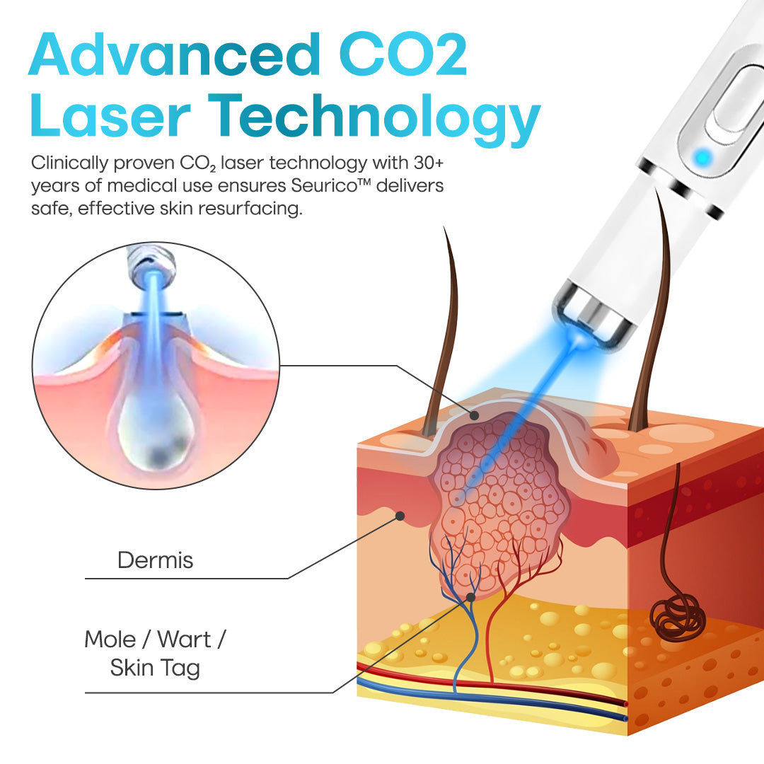 Seurico™ Painless Laser Mole & Wart Remover Pen – Fast At-Home Treatment