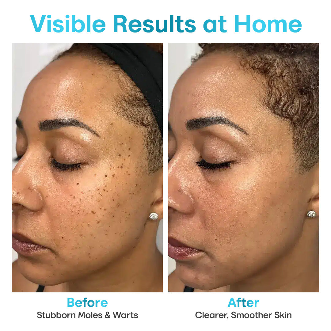 Seurico™ Painless Laser Mole & Wart Remover Pen – Fast At-Home Treatment