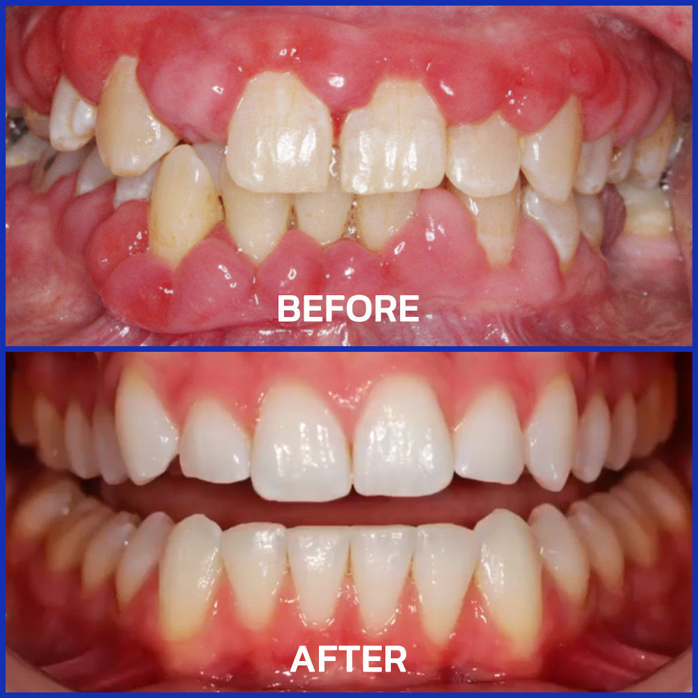 Odeiun⢠Bee Venom Treatment Oral Powder | ADA-Approved & Dentist Recommended