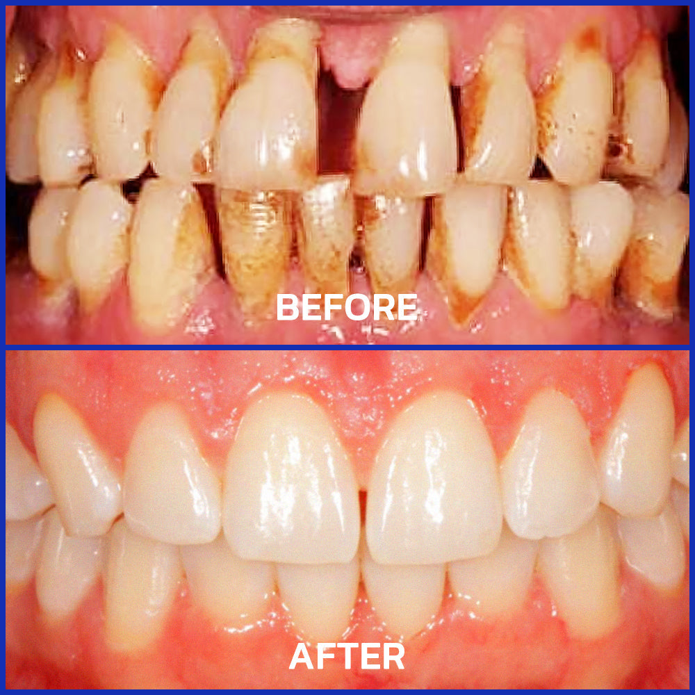 Odeiun⢠Bee Venom Treatment Oral Powder | ADA-Approved & Dentist Recommended